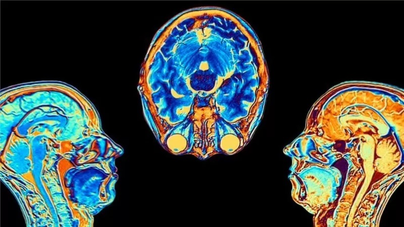 Covid:Un estudio revela cómo cambia el cerebro tras la infección