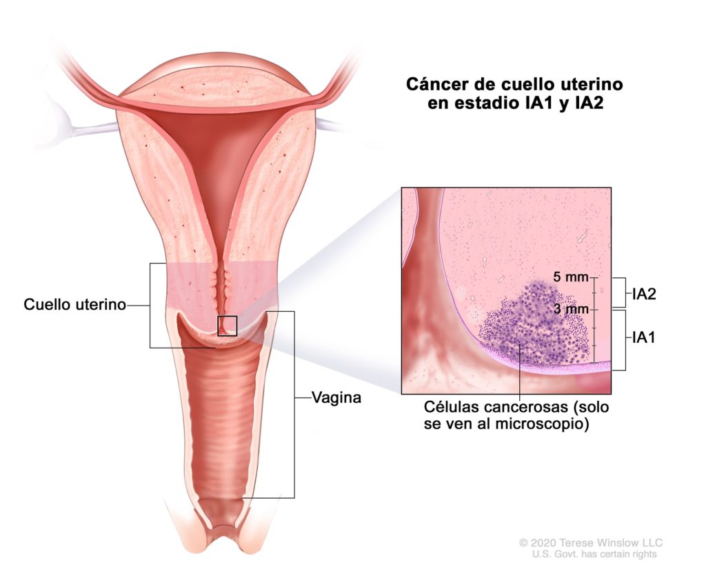 Cáncer de cervix: ¿Cómo prevenirlo y tratarlo?