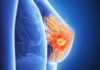 DETECCIÓN PRECOZ Y CONTROLES: LAS CLAVES PARA PREVENIR EL CÁNCER DE MAMA cancer-mama