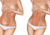 diastasis-antes-y-despues-operacion-abdomen-1-300x167